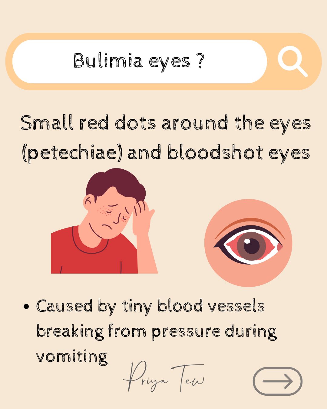 Bulimia Eyes - small red dots around the eyes 